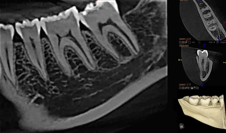 CS 8100 3D 5x5 Endo Image 2