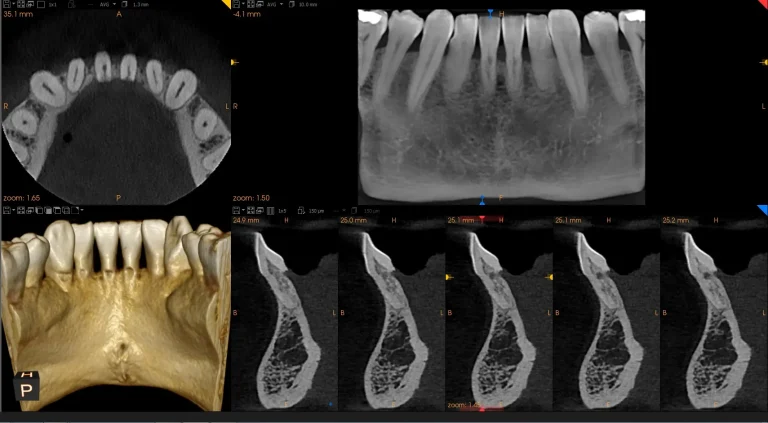 CS 8100 3D Resorption Image