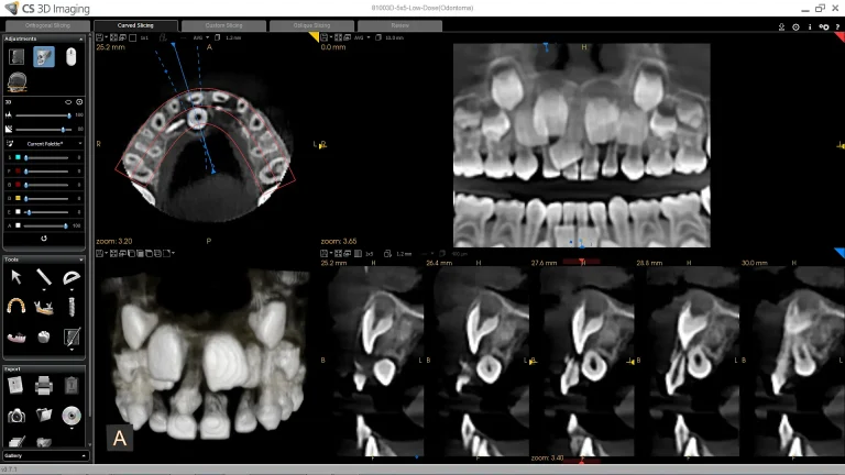 CS 8100SC 3D 5x5_Low+Dose_odontoma