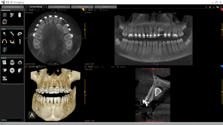 CS 8100SC 3D 8x8_impaction_brackets_1